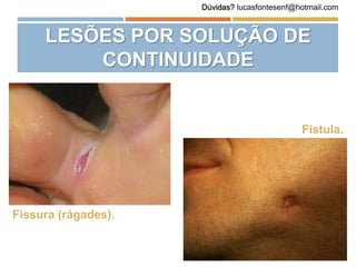 LESÕES POR SOLUÇÃO DE
CONTINUIDADE
Fissura (rágades).
Fístula.
Dúvidas? lucasfontesenf@hotmail.com
 