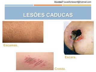 LESÕES CADUCAS
Escamas.
Crosta.
Escara.
Dúvidas? lucasfontesenf@hotmail.com
 