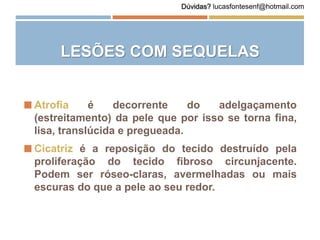 LESÕES COM SEQUELAS
 Atrofia é decorrente do adelgaçamento
(estreitamento) da pele que por isso se torna fina,
lisa, translúcida e pregueada.
 Cicatriz é a reposição do tecido destruído pela
proliferação do tecido fibroso circunjacente.
Podem ser róseo-claras, avermelhadas ou mais
escuras do que a pele ao seu redor.
Dúvidas? lucasfontesenf@hotmail.com
 