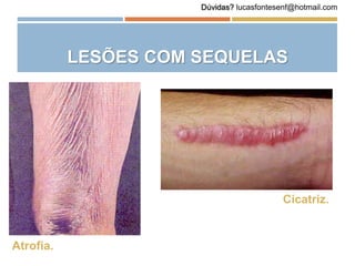 LESÕES COM SEQUELAS
Atrofia.
Cicatriz.
Dúvidas? lucasfontesenf@hotmail.com
 