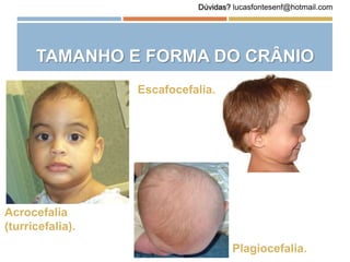 TAMANHO E FORMA DO CRÂNIO
Acrocefalia
(turricefalia).
Escafocefalia.
Plagiocefalia.
Dúvidas? lucasfontesenf@hotmail.com
 