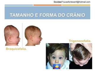 TAMANHO E FORMA DO CRÂNIO
Braquicefalia.
Trigonocefalia.
Dúvidas? lucasfontesenf@hotmail.com
 