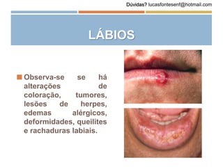 LÁBIOS
 Observa-se se há
alterações de
coloração, tumores,
lesões de herpes,
edemas alérgicos,
deformidades, queilites
e rachaduras labiais.
Dúvidas? lucasfontesenf@hotmail.com
 