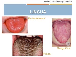LÍNGUA
De framboesa.
Pilosa.
Geográfica.
Dúvidas? lucasfontesenf@hotmail.com
 