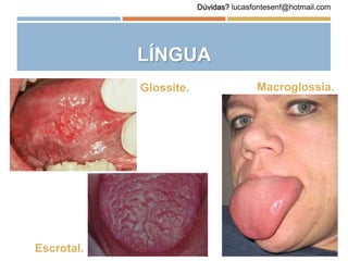 LÍNGUA
Glossite.
Escrotal.
Macroglossia.
Dúvidas? lucasfontesenf@hotmail.com
 