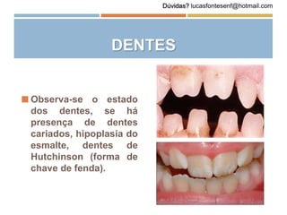 DENTES
 Observa-se o estado
dos dentes, se há
presença de dentes
cariados, hipoplasia do
esmalte, dentes de
Hutchinson (forma de
chave de fenda).
Dúvidas? lucasfontesenf@hotmail.com
 