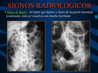 Semiologia radiologica del neumoperitoneo | PPT