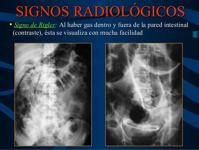 Semiologia Radiologica Del Neumoperitoneo