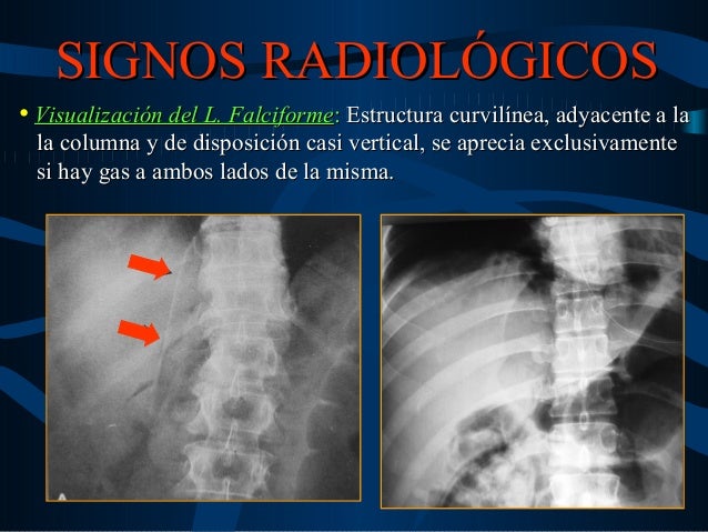 Semiologia Radiologica Del Neumoperitoneo