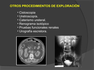 OTROS PROCEDIMIENTOS DE EXPLORACIÓN
• Cistoscopia
• Uretroscopía.
• Caterismo ureteral.
• Renograma isotópico
• Pruebas funcionales renales
• Urografía escretora.