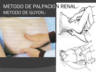 METODO DE PALPACION RENAL.-
METODO DE GUYON.-