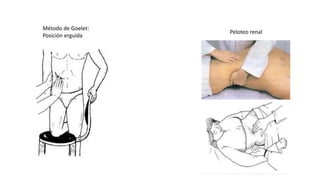 Peloteo renal
Método de Goelet:
Posición erguida
 