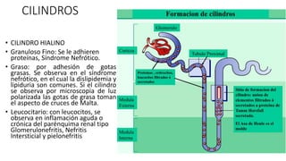 CILINDROS
• CILINDRO HIALINO
• Granuloso Fino: Se le adhieren
proteínas, Síndrome Nefrótico.
• Graso: por adhesión de gotas
grasas. Se observa en el síndrome
nefrótico, en el cual la dislipidemia y
lipiduria son comunes. Si el cilindro
se observa por microscopia de luz
polarizada las gotas de grasa toman
el aspecto de cruces de Malta.
• Leucocitario: con leucocitos, se
observa en inflamación aguda o
crónica del parénquima renal tipo
Glomerulonefritis, Nefritis
Intersticial y pielonefritis
 