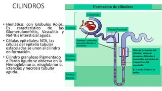 CILINDROS
• Hemático: con Glóbulos Rojos.
Es característico de las
Glomerulonefritis, Vasculitis y
Nefritis intersticial aguda.
• Células epiteliales: NTA, las
células del epitelio tubular
esfaceladas se unen al cilindro
en formación.
• Cilindro granuloso Pigmentado
o Pardo Agudo se observa en la
Hemoglobinuria, mioglobinuria,
ictericias y necrosis tubular
aguda.
 