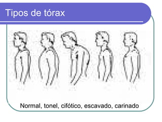 Tipos de tórax
Normal, tonel, cifótico, escavado, carinado
 