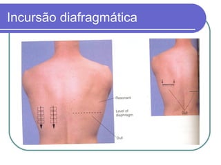 Incursão diafragmática
 