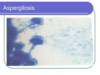 Aspergilosis
 