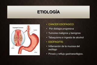 ETIOLOGÍA
• CANCER ESOFAGICO:
• Por disfagia progresiva
• Tumores malignos y benignos
• Tabaquismo e ingesta de alcohol
• ...