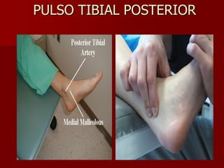 PULSO TIBIAL POSTERIOR
 