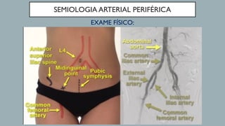 SEMIOLOGIA ARTERIAL PERIFÉRICA
EXAME FÍSICO:
 