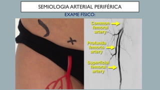 SEMIOLOGIA ARTERIAL PERIFÉRICA
EXAME FÍSICO:
 