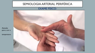 SEMIOLOGIA ARTERIAL PERIFÉRICA
EXAME FÍSICO:
Atenção
para a cor e
temperatura
 