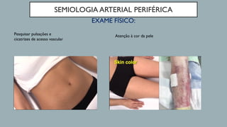 SEMIOLOGIA ARTERIAL PERIFÉRICA
EXAME FÍSICO:
Pesquisar pulsações e
cicatrizes de acesso vascular
Atenção à cor da pele
 