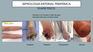 SEMIOLOGIA ARTERIAL PERIFÉRICA
EXAME FÍSICO:
Atenção à cor da pele e à falta de pelos,
alterações discretas nas fases iniciais
Gangrena Gangrena Vasoespasmo Infecção
 