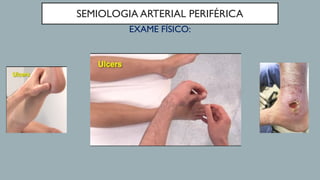 SEMIOLOGIA ARTERIAL PERIFÉRICA
EXAME FÍSICO:
 