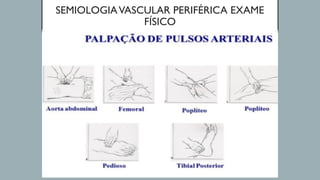 SEMIOLOGIAVASCULAR PERIFÉRICA EXAME
FÍSICO
 