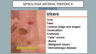 SEMIOLOGIA ARTERIAL PERIFÉRICA
EXAME FÍSICO:
 