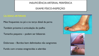INSUFICIÊNCIA ARTERIAL PERIFÉRICA
EXAME FÍSICO-INSPEÇÃO
ÚLCERAS ARTERIAIS
Mais frequentes no pé e no terço distal da perna
Também próximo à articulação do joelho
Tamanho pequeno – podem ser bilaterais
Dolorosas – Bordos bem delimitados não sangrantes
Fundo com crostas enegrecidas e aderidas
 