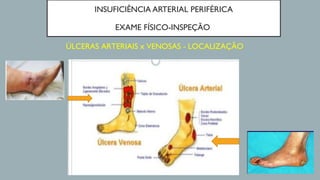 INSUFICIÊNCIA ARTERIAL PERIFÉRICA
EXAME FÍSICO-INSPEÇÃO
ÚLCERAS ARTERIAIS x VENOSAS - LOCALIZAÇÃO
 