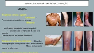 SEMIOLOGIAVENOSA - EXAME FÍSICO INSPEÇÃO
VENOSA:
Turgência venosa jugular:
Unilateral –
Pneumotórax, compressão por tumores,
Bilateral:
Insuficiencia ventricular direita ou global
Síndrome de compressão da veia cava
superior
Grandes ascites e tumores abdominais
Varizes de membros inferiores – dilatações
patológicas por alterações da túnica média das veias.
Quase exclusivas de
membros inferiores
 