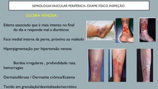SEMIOLOGIAVASCULAR PERIFÉRICA- EXAME FÍSICO INSPEÇÃO
ÚLCERA VENOSA:
Edema associado que é mais intenso no final
do dia e responde mal a diuréticos
Face medial interna da perna, próximo ao maléolo
Hiperpigmentação por hipertensão venosa
Bordos irregulares , profundidade rasa,
hemorragias
Dermatofibrose / Dermatite crônica/Eczema
Tecido em granulação/desvitalizado/necrótico
 