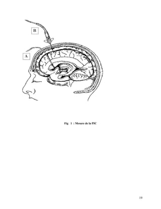 19
Fig 1 : Mesure de la PIC
 