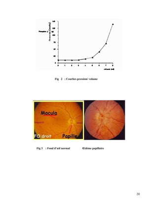 20
Fig 2 : Courbes pression/ volume
Fig 3 : Fond d’œil normal Œdème papillaire
 