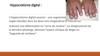 Doigt En Rond Semiologie respiratoire | PPTX