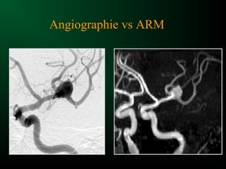 Angiographie vs ARM
 