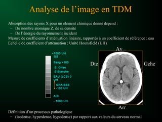 Analyse de l’image en TDM
Absorption des rayons X pour un élément chimique donné dépend :
– Du nombre atomique Z, de sa densité
– De l’énergie du rayonnement incident
Mesure de coefficients d’atténuation linéaire, rapportés à un coefficient de référence : eau
Echelle de coefficient d’atténuation : Unité Hounsfield (UH)
Définition d’un processus pathologique
– (isodense, hyperdense, hypodense) par rapport aux valeurs du cerveau normal
+1000 UH
OS
AIR
- 1000 UH
EAU (LCS) 0
UH
S Blanche
Sang +100
GRAISSE
-100 UH
S. Grise
Dte
Av
Gche
Arr
 