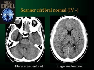 Scanner cérébral normal (IV -)
Etage sous tentoriel Etage sus tentoriel
 