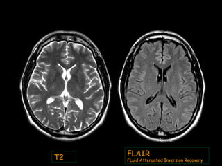 T2
FLAIR
FLuid Attenuated Inversion Recovery
 