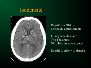 Isodensité
Densité des NGC =
densité du cortex cérébral
L : noyau lenticulaire
Th : Thalamus
NC : Tête du noyau caudé
Densité s. grise > s. blanche
 