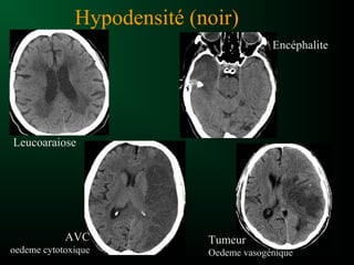 Hypodensité (noir)
Leucoaraiose
Encéphalite
AVC
oedeme cytotoxique
Tumeur
Oedeme vasogénique
 