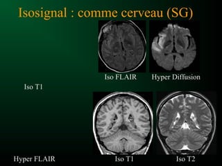 Isosignal : comme cerveau (SG)
Iso T1
Hyper DiffusionIso FLAIR
Hyper FLAIR Iso T2Iso T1
 