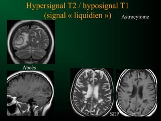 Hypersignal T2 / hyposignal T1
(signal « liquidien »)
Abcès
Astrocytome
SEP
 