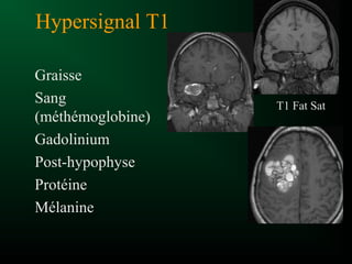 Hypersignal T1
Graisse
Sang
(méthémoglobine)
Gadolinium
Post-hypophyse
Protéine
Mélanine
T1 Fat Sat
 
