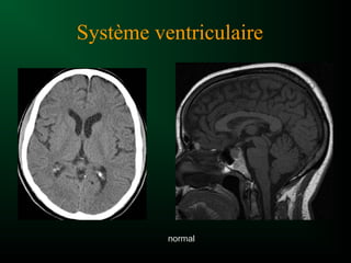 Système ventriculaire
normal
 