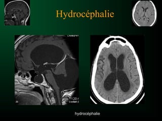 Hydrocéphalie
hydrocéphalie
 