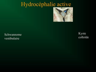 Hydrocéphalie active
Kyste
colloïde
Schwannome
vestibulaire
 